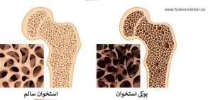 پوکی استخوان ; روش های پیشگیری آن